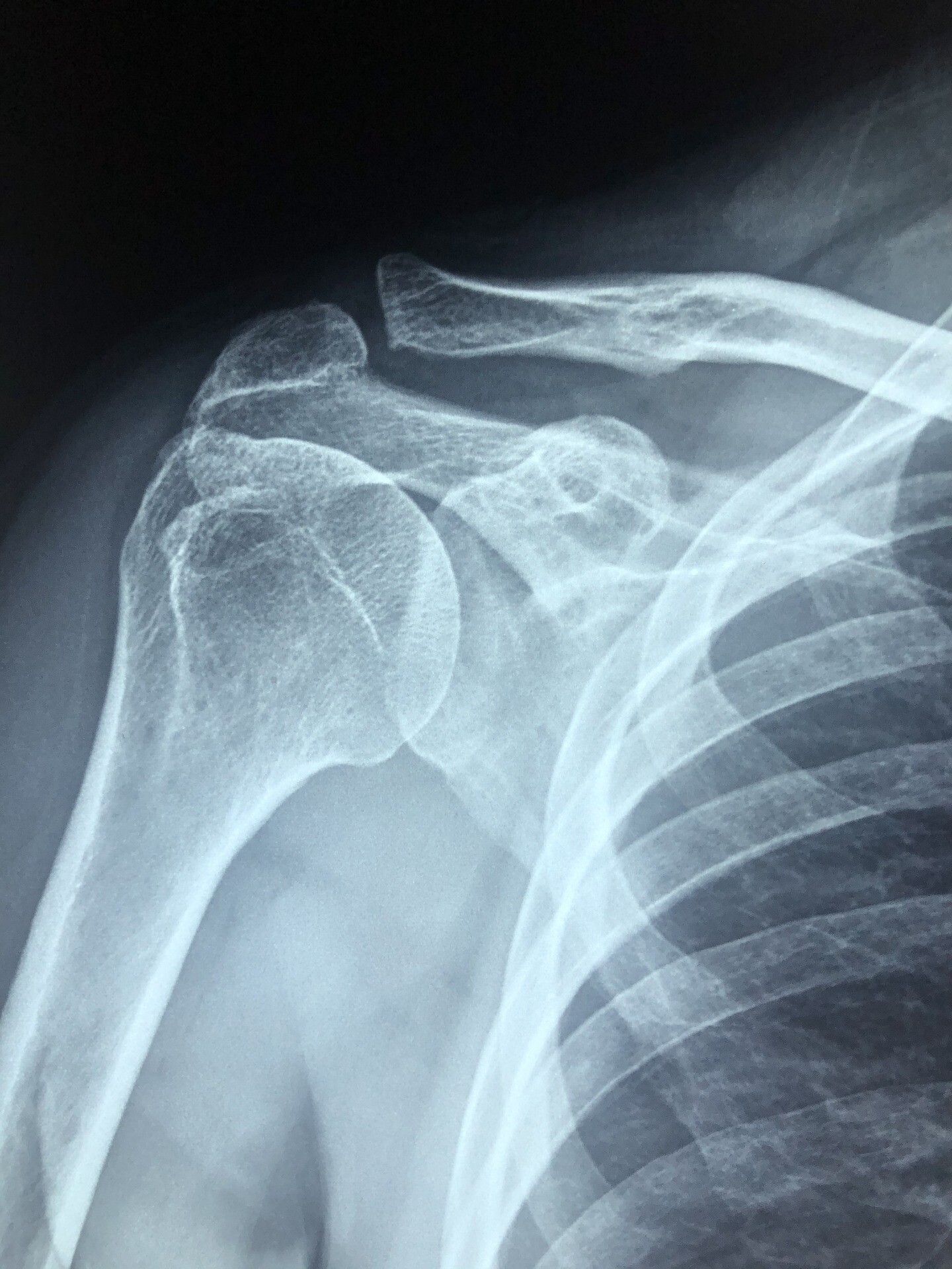 röntgenbild schulter